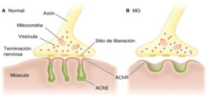 Trasmisión del impulso nervioso en la Miastenia Gravis (MG)